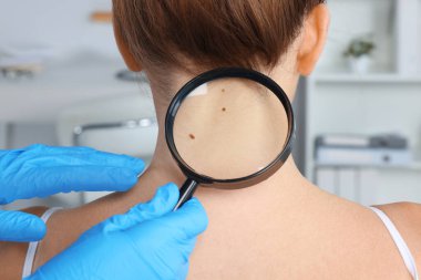 Dermatolog, klinikte büyüteçle hastanın doğum lekesini inceliyor.