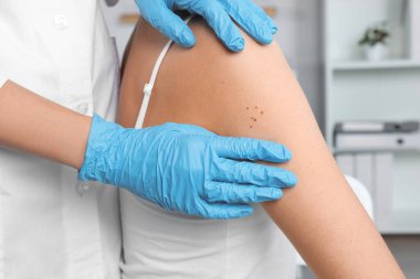 Dermatolog klinikte hastanın doğum lekesini inceliyor.