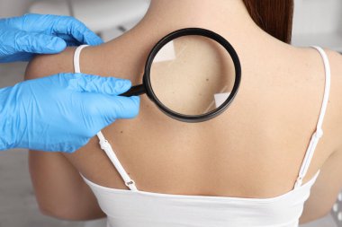Dermatolog, klinikte büyüteçle hastanın doğum lekesini inceliyor.