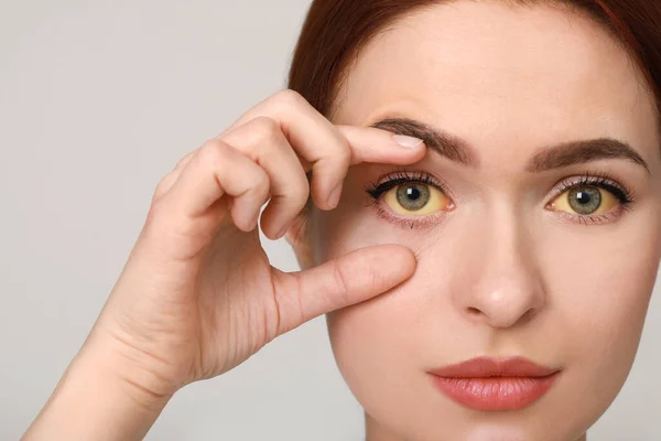 Γυναίκα Κίτρινα Μάτια Ανοιχτό Γκρι Φόντο Συμπτώματα Ηπατίτιδας — Φωτογραφία Αρχείου