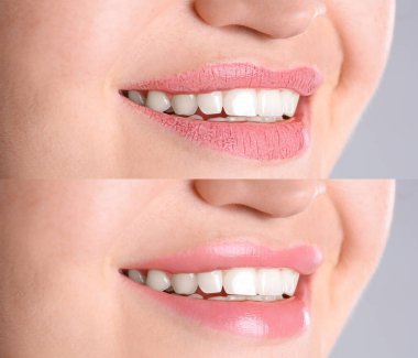 Gri arka planda dudak kremi kullanmadan önce ve sonra kadın fotoğraflarıyla kolaj, yakın plan