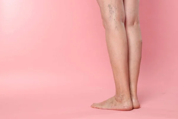 stock image Closeup view of woman with varicose veins on pink background. Space for text