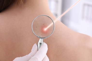 Laser mole removal. Doctor looking at patient's skin through magnifying glass during procedure in clinic, closeup