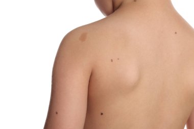 Beyaz arka planda doğum lekeleri olan erkek vücudunun yakın çekimi.