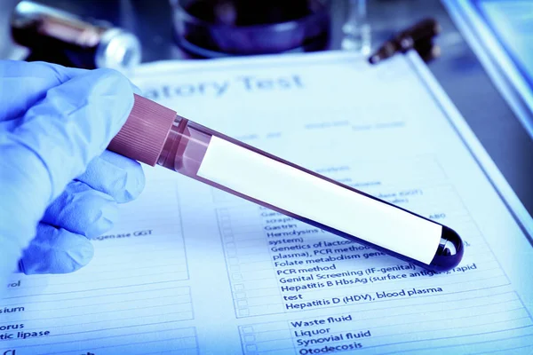 Laboratóriumi Dolgozó Kémcsővel Vérmintával Orvosi Lapon Közelről Színes Tónus — Stock Fotó