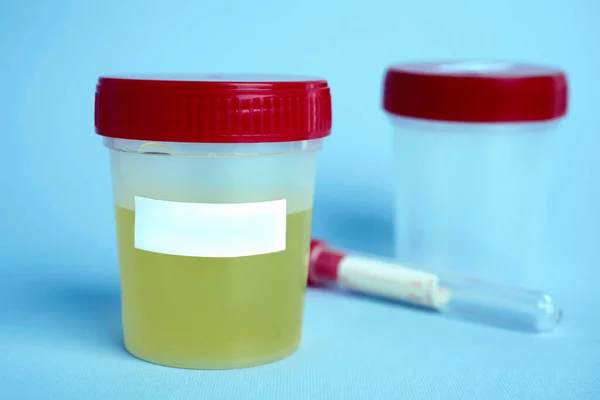 Jar Dengan Sampel Urin Pada Latar Belakang Biru Muda Spasi — Stok Foto
