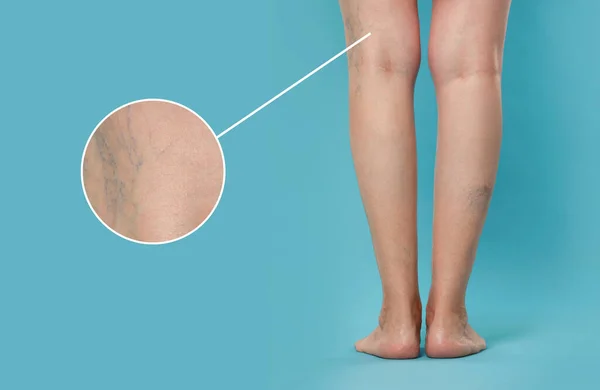 Woman suffering from varicose veins on light blue background, closeup. Magnified skin surface showing affected area