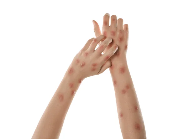 Mujer Con Sarpullido Que Sufre Virus Viruela Sobre Fondo Blanco — Foto de Stock