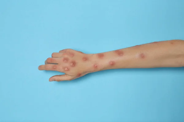 Woman with rash suffering from monkeypox virus on light blue background, closeup