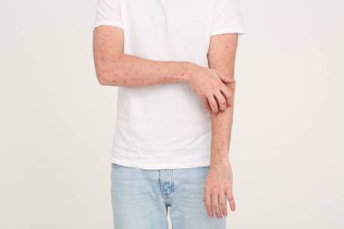 Bej arka planda maymun çiçeği virüsünden muzdarip bir adam.