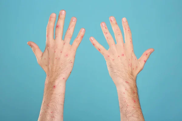 Man with rash suffering from monkeypox virus on light blue background, closeup