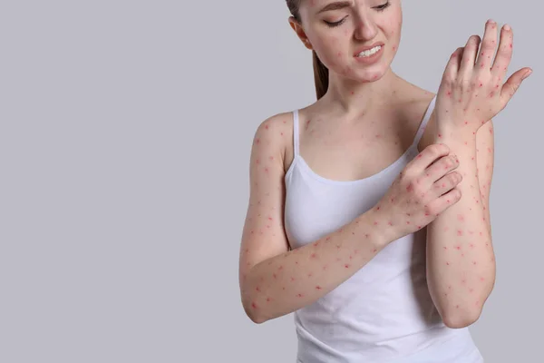 Woman Rash Suffering Monkeypox Virus Light Grey Background Closeup Space — Stock Photo, Image