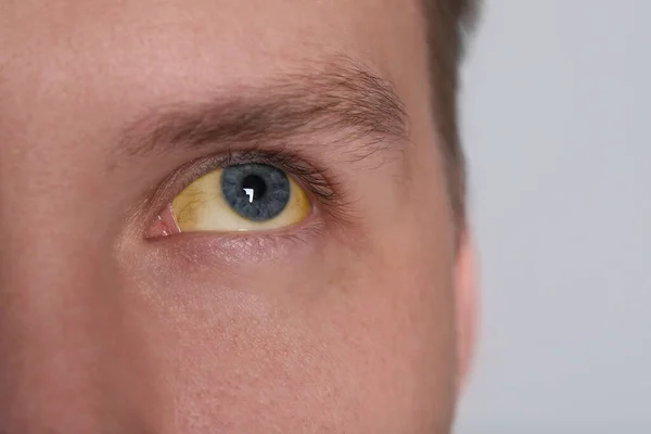 Homem Com Olhos Amarelos Fundo Claro Close Sintoma Hepatite — Fotografia de Stock