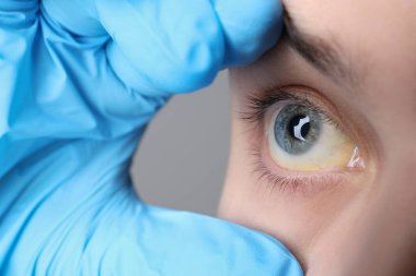 Doktor, gri arka planda sarı gözlü kadını kontrol ediyor. Yakın plan. Hepatit belirtileri