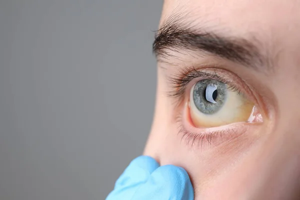 Doctor checking woman with yellow eyes on grey background, closeup. Symptom of hepatitis