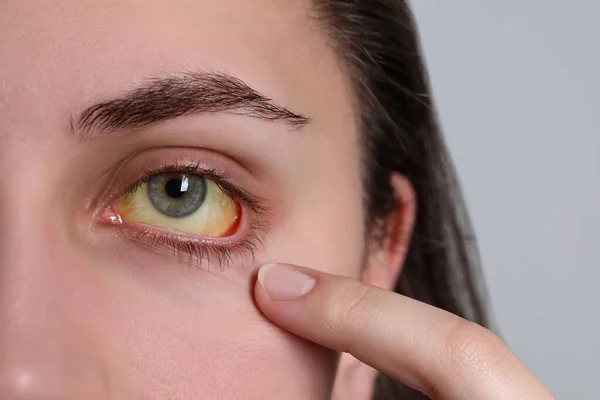 Frau Mit Gelben Augen Auf Hellem Hintergrund Nahaufnahme Symptom Einer — Stockfoto