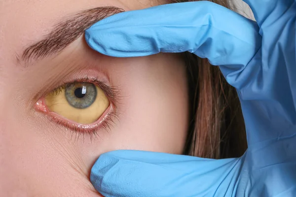 Médico Revisando Mujer Con Ojos Amarillos Primer Plano Síntoma Hepatitis — Foto de Stock