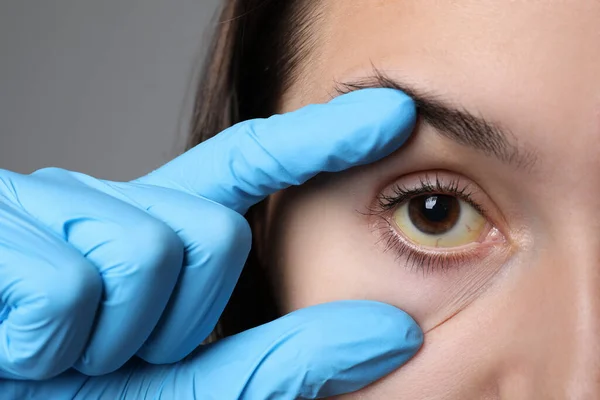 Doutor Verificando Mulher Com Olhos Amarelos Fundo Cinza Close Sintoma — Fotografia de Stock