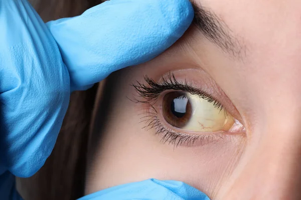 Doutor Verificando Mulher Com Olhos Amarelos Close Sintoma Hepatite — Fotografia de Stock