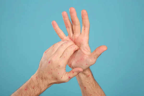 Man with rash suffering from monkeypox virus on light blue background, closeup