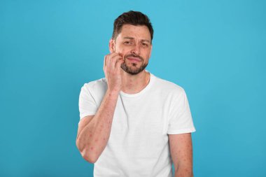 Açık mavi arka planda kızarıklık hastalığı virüsü olan bir adam.