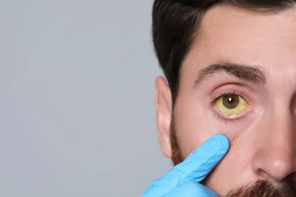 Arzt Kontrolliert Mann Mit Gelben Augen Auf Grauem Hintergrund Nahaufnahme — Stockfoto