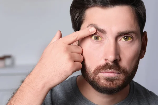 Uomo Con Gli Occhi Gialli Sfondo Sfocato Sintomo Epatite — Foto Stock