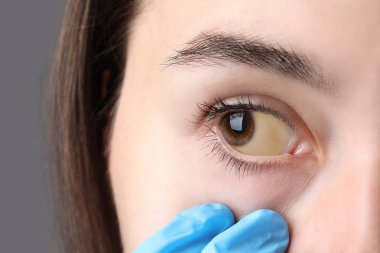 Doktor, gri arka planda sarı gözlü kadını kontrol ediyor. Yakın plan. Hepatit belirtileri