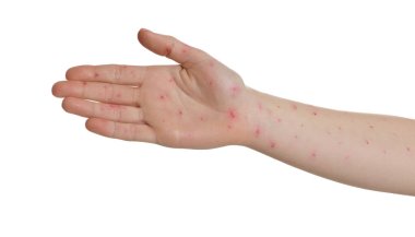 Woman with rash suffering from monkeypox virus on white background, closeup clipart
