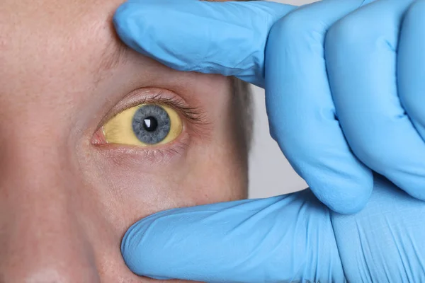 Doutor Verificando Homem Com Olhos Amarelos Fundo Claro Close Sintoma — Fotografia de Stock