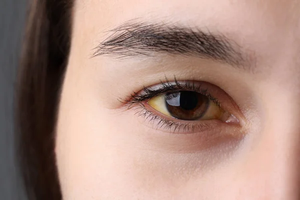黄眼睛的女人灰色背景 肝炎的症状 — 图库照片