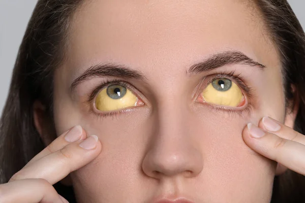 Mujer Con Ojos Amarillos Sobre Fondo Claro Primer Plano Síntoma — Foto de Stock