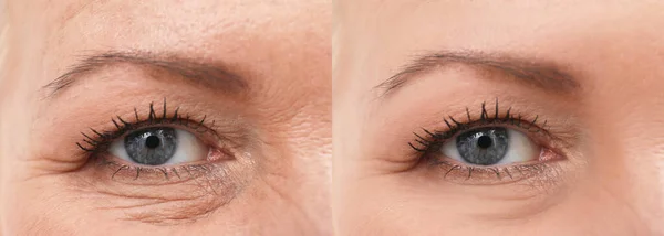 Kozmetik Ameliyatlar Sayesinde Kadın Daha Iyi Görünüyor Yenilenmeden Önce Sonra — Stok fotoğraf
