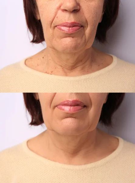 化粧品の手順のために良く見える女性 若返りの前と後の白い背景の写真とコラージュ クローズアップ — ストック写真