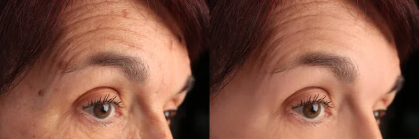 化粧品の手順のために良く見える女性 若返りの前と後の写真とコラージュ クローズアップ — ストック写真