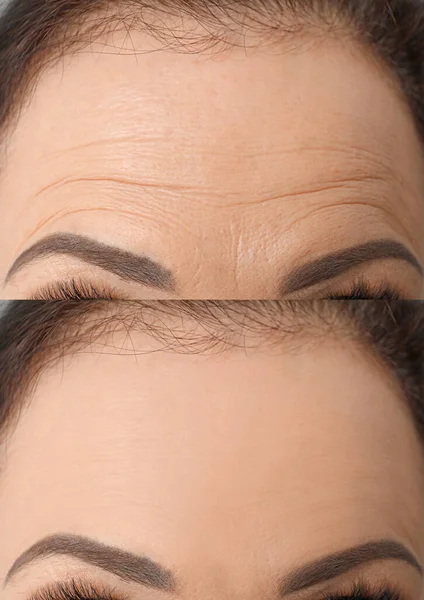 Wanita Sebelum Dan Setelah Meremajakan Prosedur Kolase Dengan Foto Closeup — Stok Foto