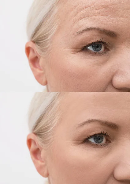 Kozmetik Ameliyatlar Sayesinde Kadın Daha Iyi Görünüyor Yenilenmeden Önce Sonra — Stok fotoğraf
