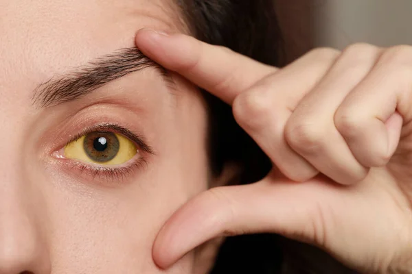 Kobieta Żółtymi Oczami Niewyraźnym Tle Zbliżenie Objawy Zapalenia Wątroby — Zdjęcie stockowe