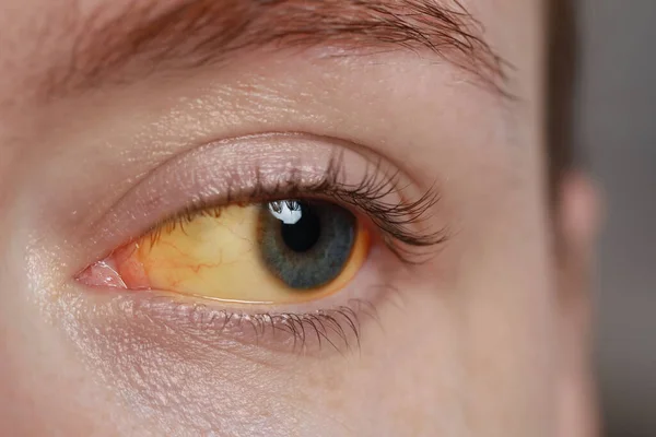 Kobieta Żółtymi Oczami Niewyraźnym Tle Zbliżenie Objawy Zapalenia Wątroby — Zdjęcie stockowe