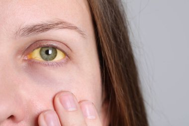 Woman with yellow eyes on light background, closeup. Symptom of hepatitis clipart