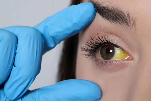 Doutor Verificando Mulher Com Olhos Amarelos Fundo Claro Close Sintoma — Fotografia de Stock
