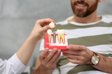 Doktor klinikte hasta diş implantının eğitim modelini gösteriyor.