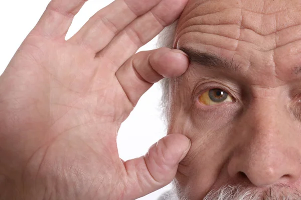 年长的男人 黄眼睛 白色背景 肝炎的症状 — 图库照片
