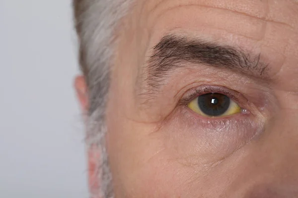 Älterer Mann Mit Gelben Augen Auf Hellem Hintergrund Nahaufnahme Symptom — Stockfoto