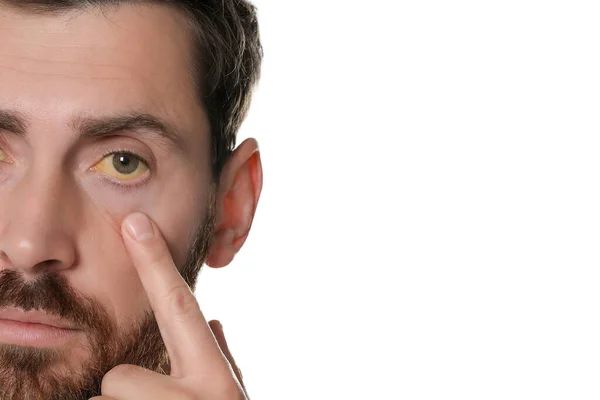 Homem Com Olhos Amarelos Fundo Branco Close Sintoma Hepatite — Fotografia de Stock