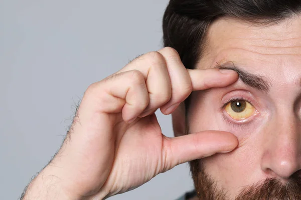 Mann Mit Gelben Augen Auf Grauem Hintergrund Nahaufnahme Symptom Einer — Stockfoto