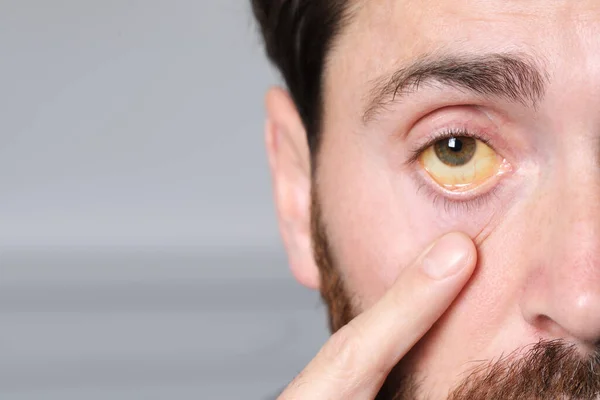 Mann Mit Gelben Augen Auf Verschwommenem Hintergrund Nahaufnahme Symptom Einer — Stockfoto