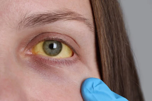 Médico Revisando Mujer Con Ojos Amarillos Sobre Fondo Claro Primer —  Fotos de Stock