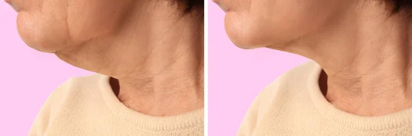 분홍색 배경에 피부를 강화하는 치료를 여성의 콜라주 클로즈업 — 스톡 사진