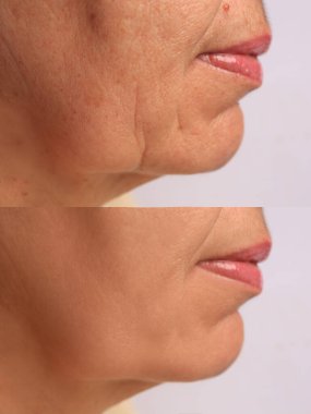 Yenilenme işleminden önce ve sonra bir kadın. Beyaz arkaplanda fotoğraflı kolaj, yakın plan